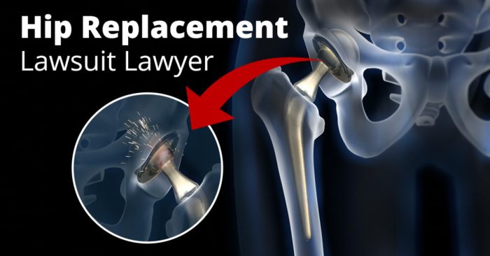 Defective Hip Implants Lawsuit | Attorney Jonathan Kline P.A.